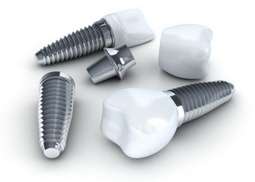 Dental implants  | American Fork Dental Center
