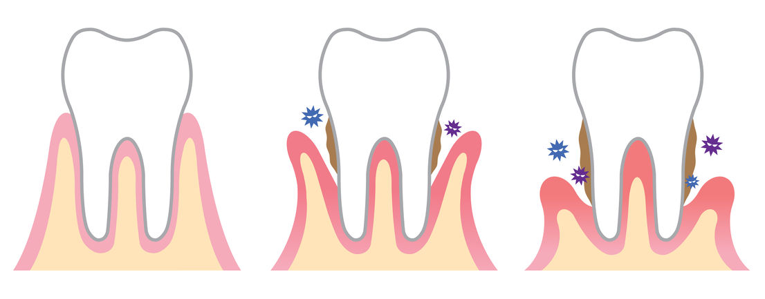 Gum disease treatment (Periodontics)  | American Fork Dental Center