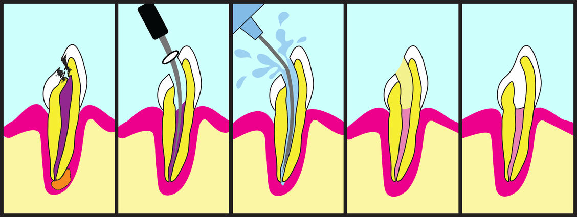 Root canals  | American Fork Dental Center