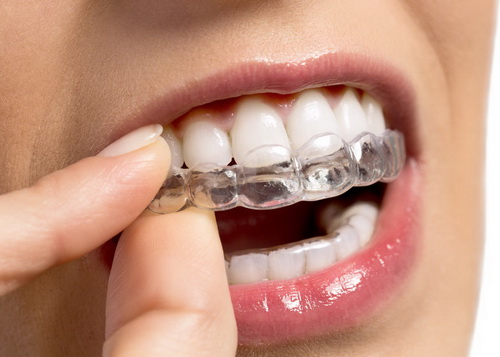 Veneers | American Fork Dental Center
